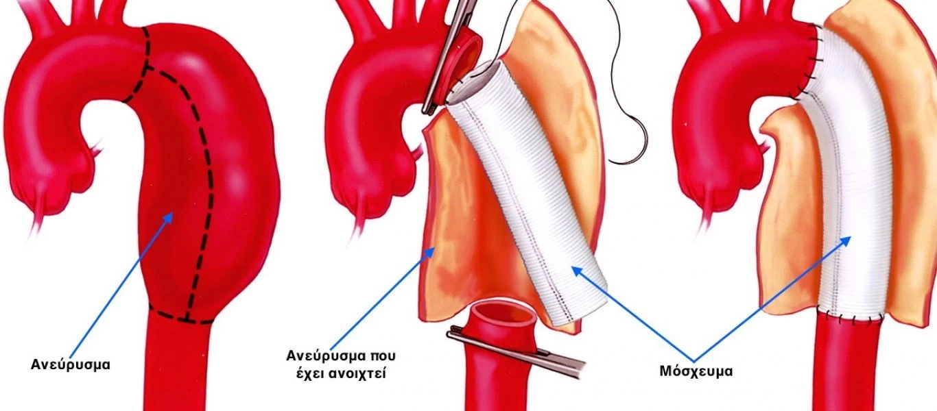 Δείτε πότε μπορεί να αποβεί μοιραίο για τη ζωή του ασθενούς το ανεύρυσμα αορτής